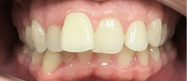 Устранение протрузии верхних резцов