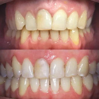 Исправление прикуса