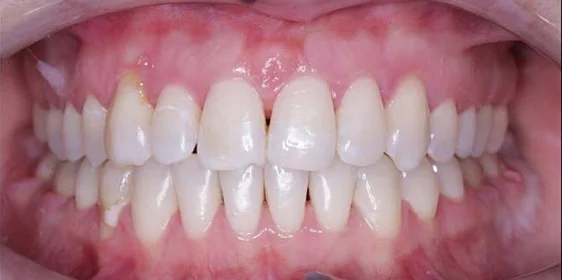 Лечение прикуса на брекет-системе