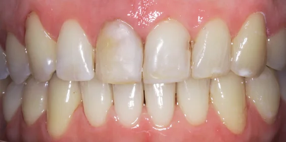 Исправление прикуса