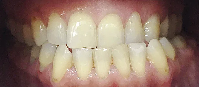 Исправление мезиального прикуса на брекетах