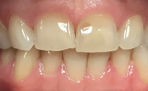 Нормализация смыкания и устранение скученности