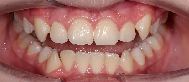 Глубокий прикус, скученность на нижней челюсти