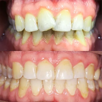 Исправление одностороннего дистального прикуса