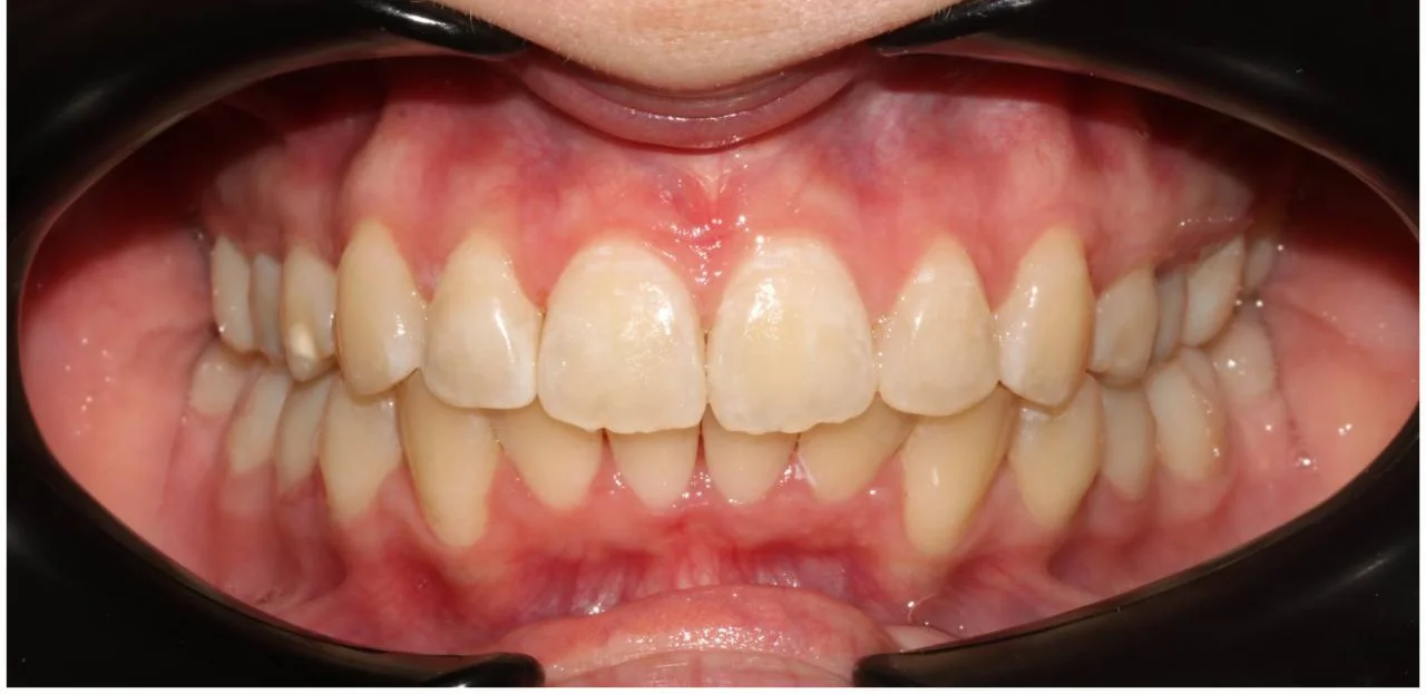 Ортодонтическое лечение на системе Click