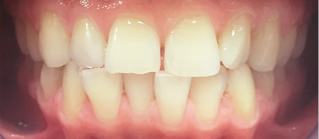 Исправление прикуса элайнерами Инвизилайн