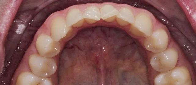 Исправление скученности фронтального отдела