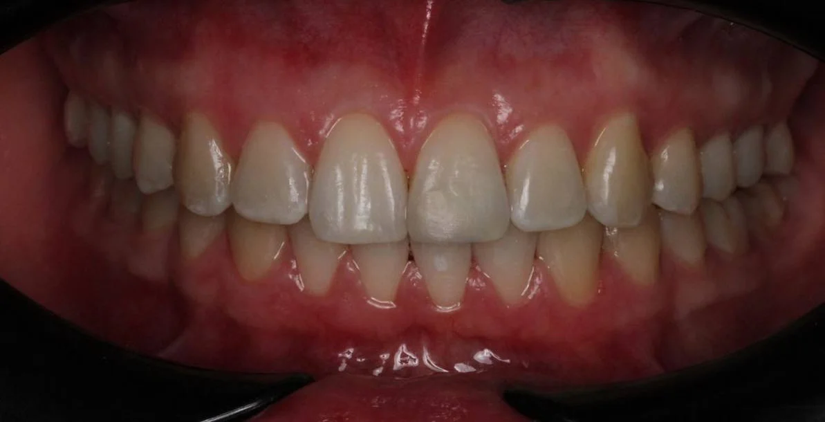 Лечение дистальной окклюзии на брекет-системе