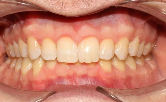 Ортодонтическое лечение на элайнерах