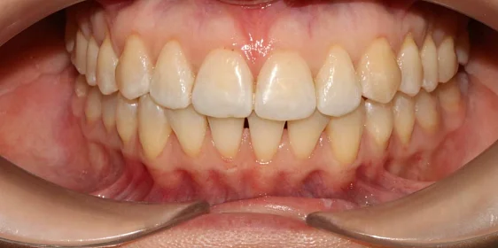 Лечение скученности зубов элайнерами