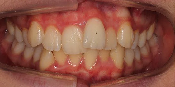 Ортодонтическое лечение на элайнерах