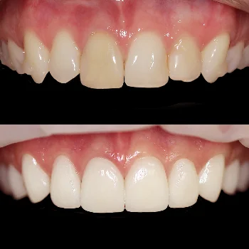 Улучшение эстетики верхних зубов после ортодонтического лечения