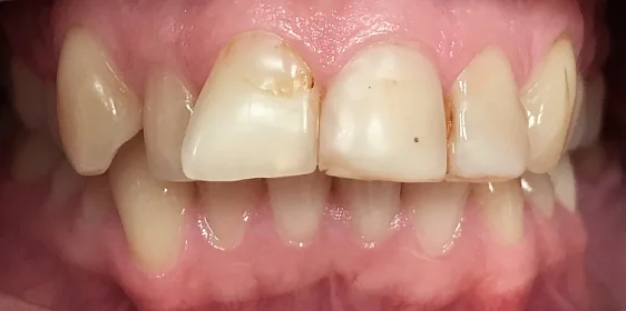 Подготовка зубных рядов к последующей установке виниров