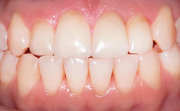 Лечение прикуса с последующей ортопедией верхних зубов