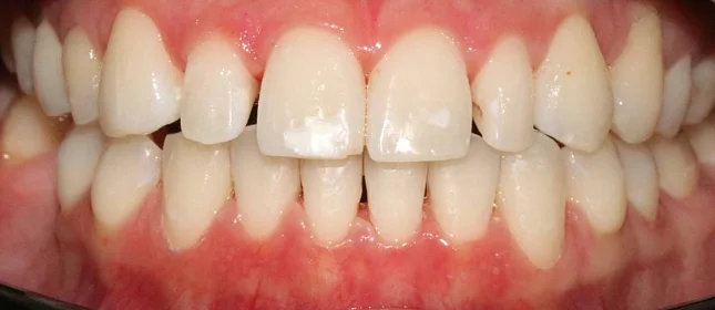 Коррекция аномалии положения зубов на элайнерах