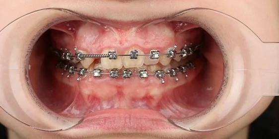 Лечение скученности зубов на брекет-системе