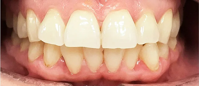 Устранение бипротрузии верхних и нижних резцов