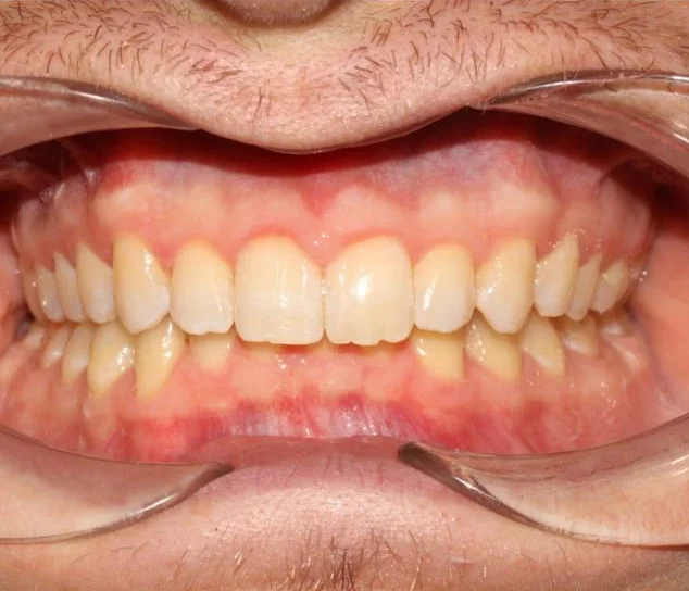 Ортодонтическое лечение на элайнерах