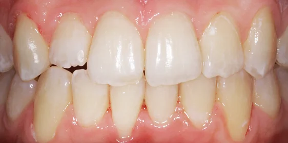 Завершающий этап лечения скученности и обратного перекрытия