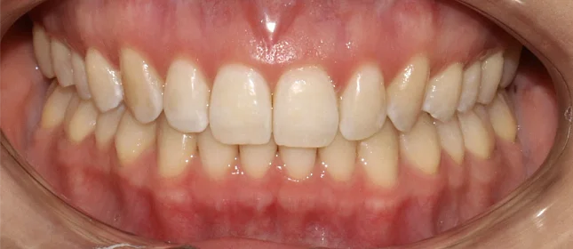 Ортодонтическое лечение на элайнерах №9