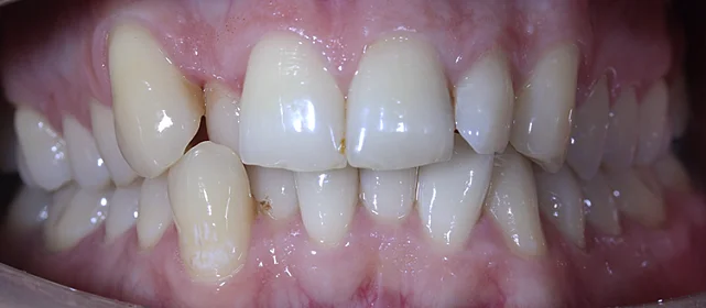 Исправления скученности верхних и нижних резцов