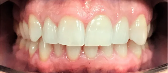 Исправление прикуса. 27 кап, 14 месяцев лечения