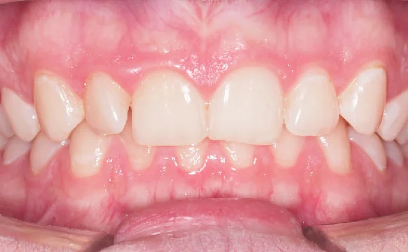 Исправление прикуса. 29 кап, 7 месяцев лечения