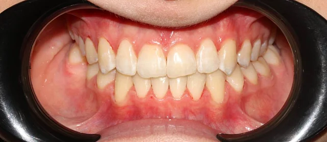 Ортодонтическое лечение на элайнерах №1