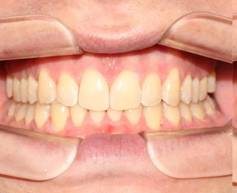 Установка ретейнеров на нижнюю и верхнюю челюсть