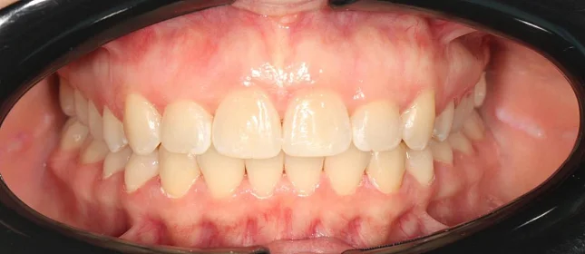 Лечение cкученности на нижней челюсти на элайнерах