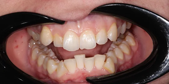 Лечение аномалии соотношения зубных дуг элайнерами