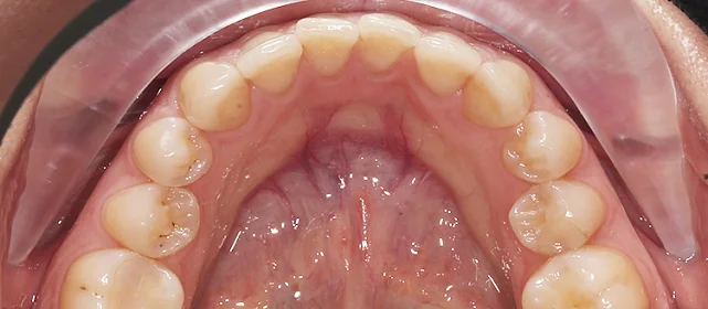 Коррекция скученности на элайнерах