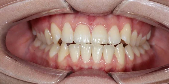 Ортодонтическое лечение на элайнерах