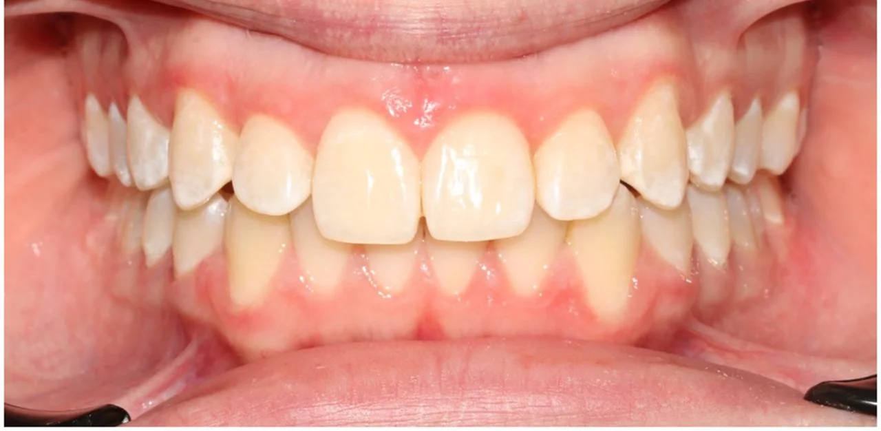 Ортодонтическое лечение на системе Click