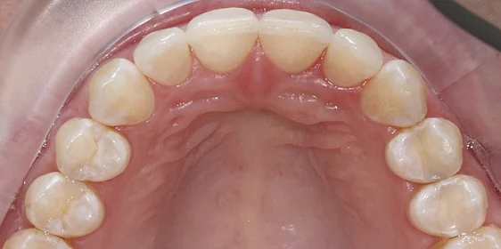 Изменение скученности зубов с помощью системы Invisalign