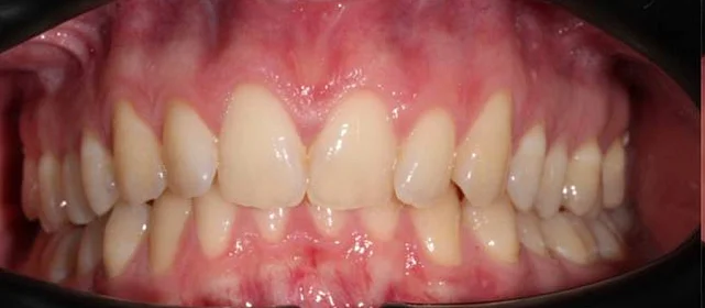 Установка ретейнеров на нижнюю и верхнюю челюсть