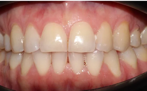 Ортодонтическое лечение на элайнерах