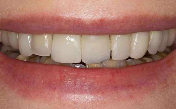 Установка виниров