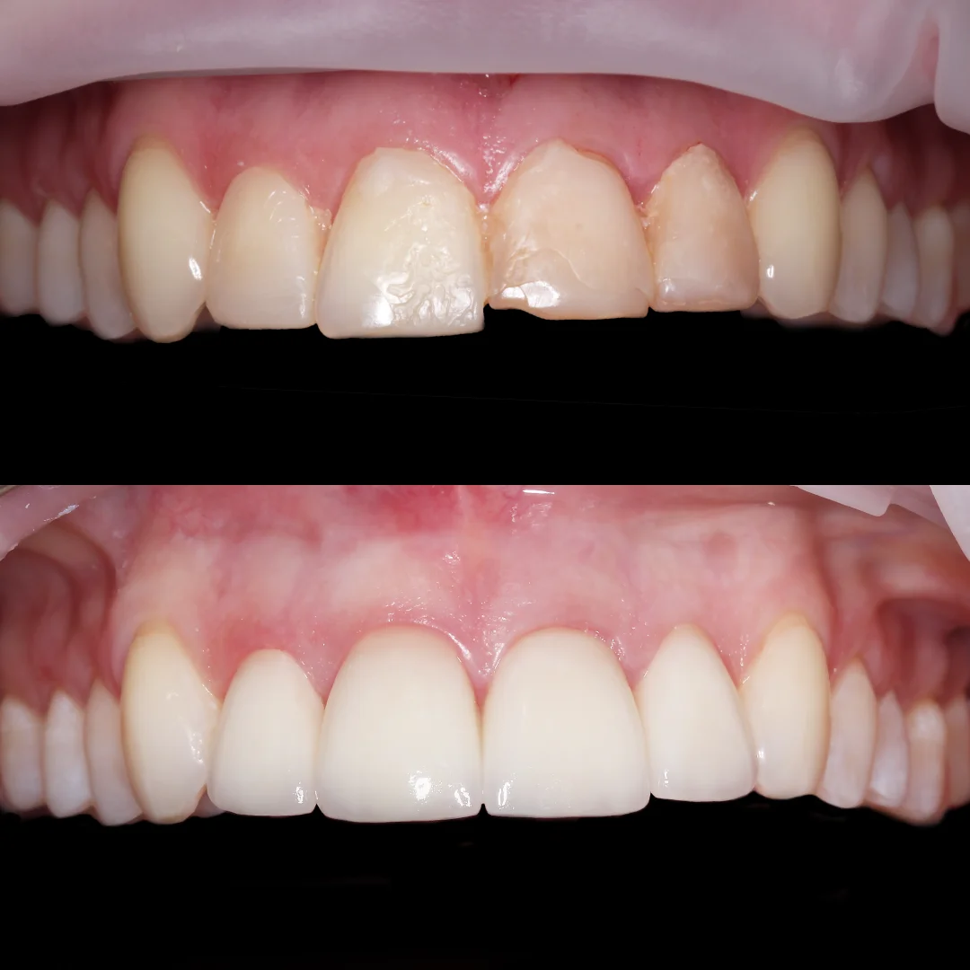 Устранение эстетического дефекта винирами