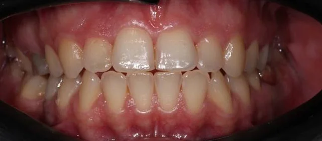 Лечение аномалии соотношений зубных дуг на элайнерах