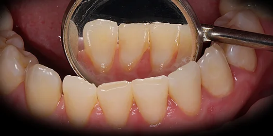 Снятие зубных отложений с помощью ультразвука и аппарата Air-Flow