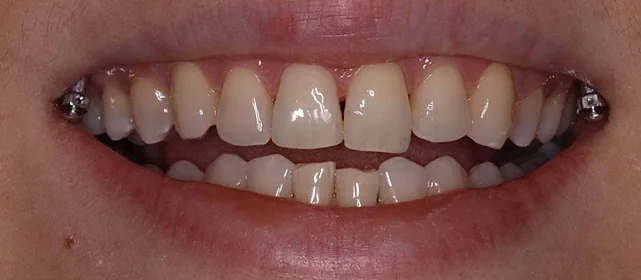 Эстетическая реставрация фронтальной группы зубов