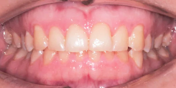 Исправление прикуса. 17 кап, 9 месяцев лечения