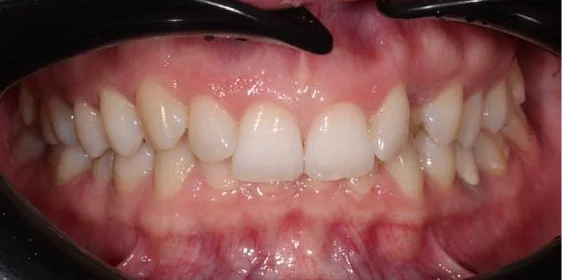 Коррекция дистальной окклюзия на брекет-системе