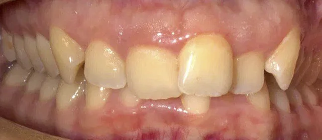 Лечение дистального прикуса на брекетах