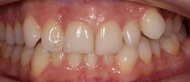 Ортодонтическое лечение на элайнерах №7