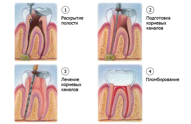 лечение каналов периодонтита
