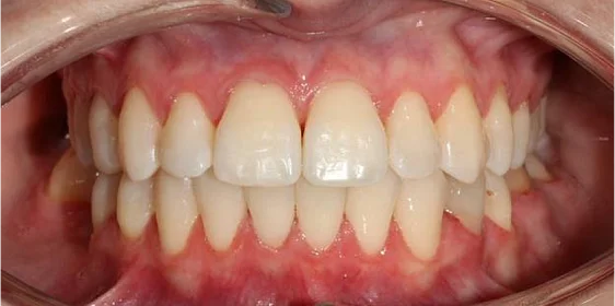 Лечение протрузии верхних резцов на брекет-системе