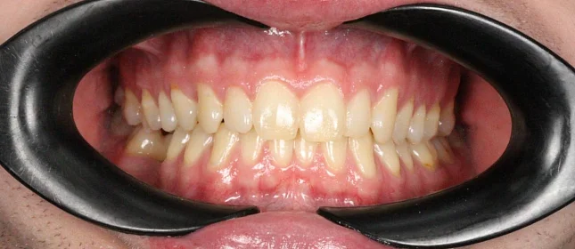 Ортодонтическое лечение на системе Click №6