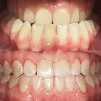 Исправление мезиального прикуса с помощью элайнеров Invisalign и минивинтов